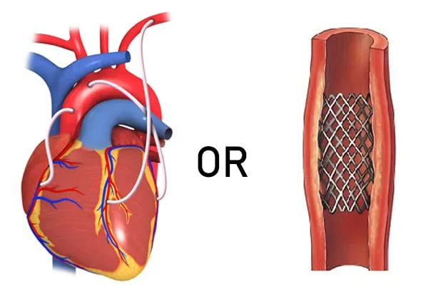 استنت قلبی (Stent) چیست؟
