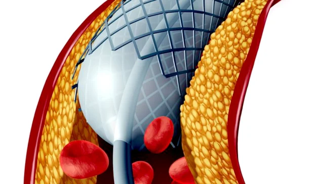 چه زمانی آنژیوگرافی لازم است؟ 15 چه زمانی آنژیوگرافی لازم است؟