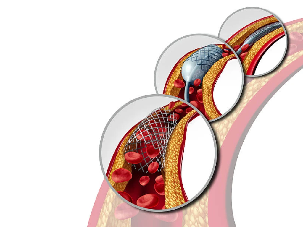 چه زمانی آنژیوگرافی لازم است؟ 16 چه زمانی آنژیوگرافی لازم است؟