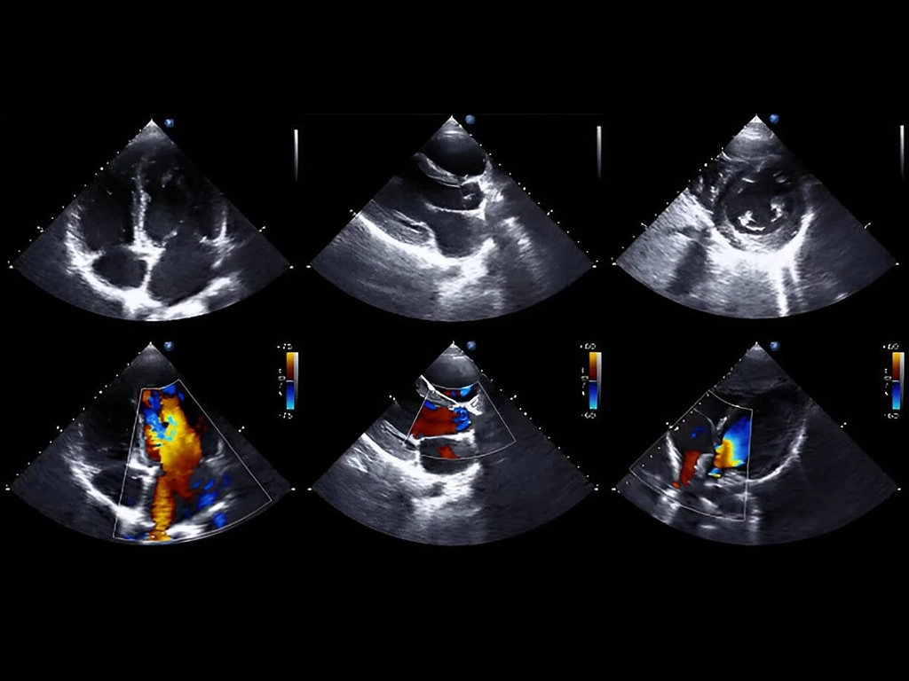 انواع اکوکاردیوگرافی قلب و کاربردهای آن 21 انواع اکو قلب