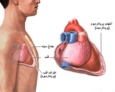 پریکاردیت ویروسی