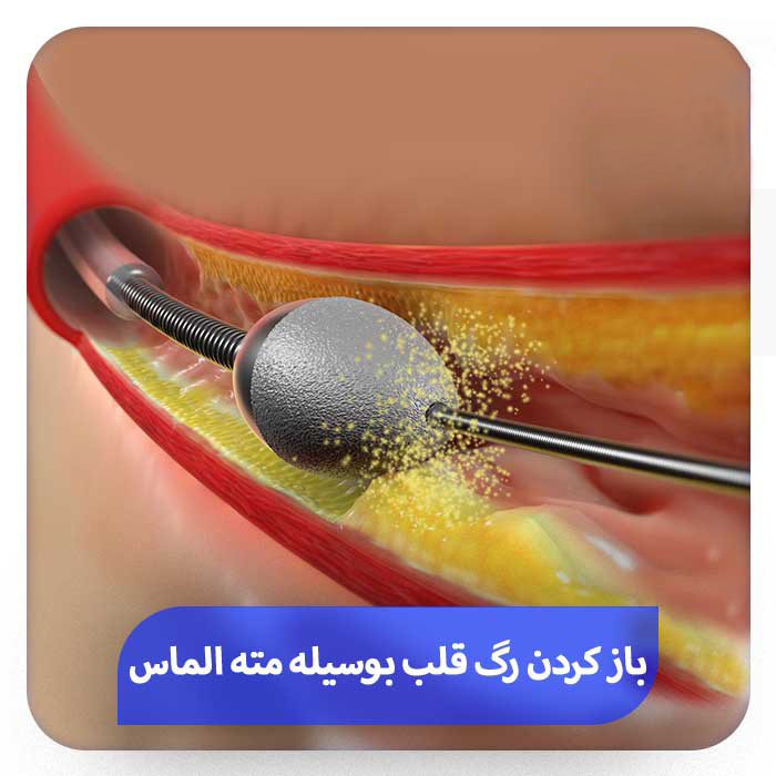 تکنیک مته الماسی در آنژیوپلاستی قلب