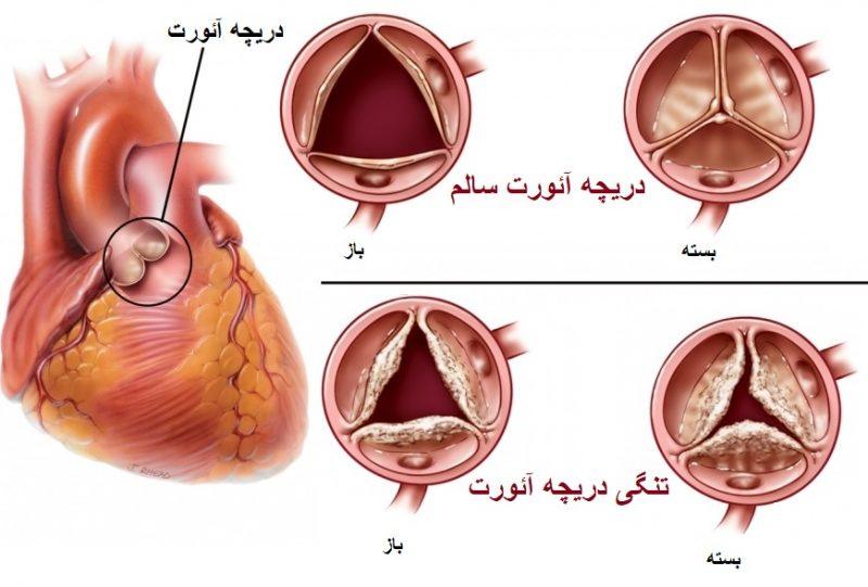 تنگی دریچه میترال و علائم آن